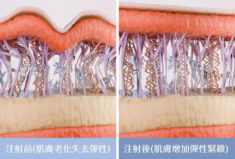 逆時針 注射效果 