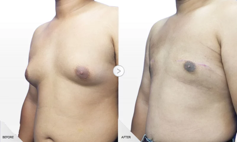 邱建智 男性女乳 一字