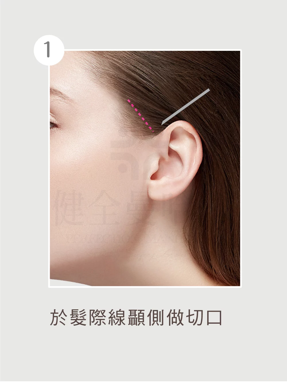 顳側拉皮 顳側 01