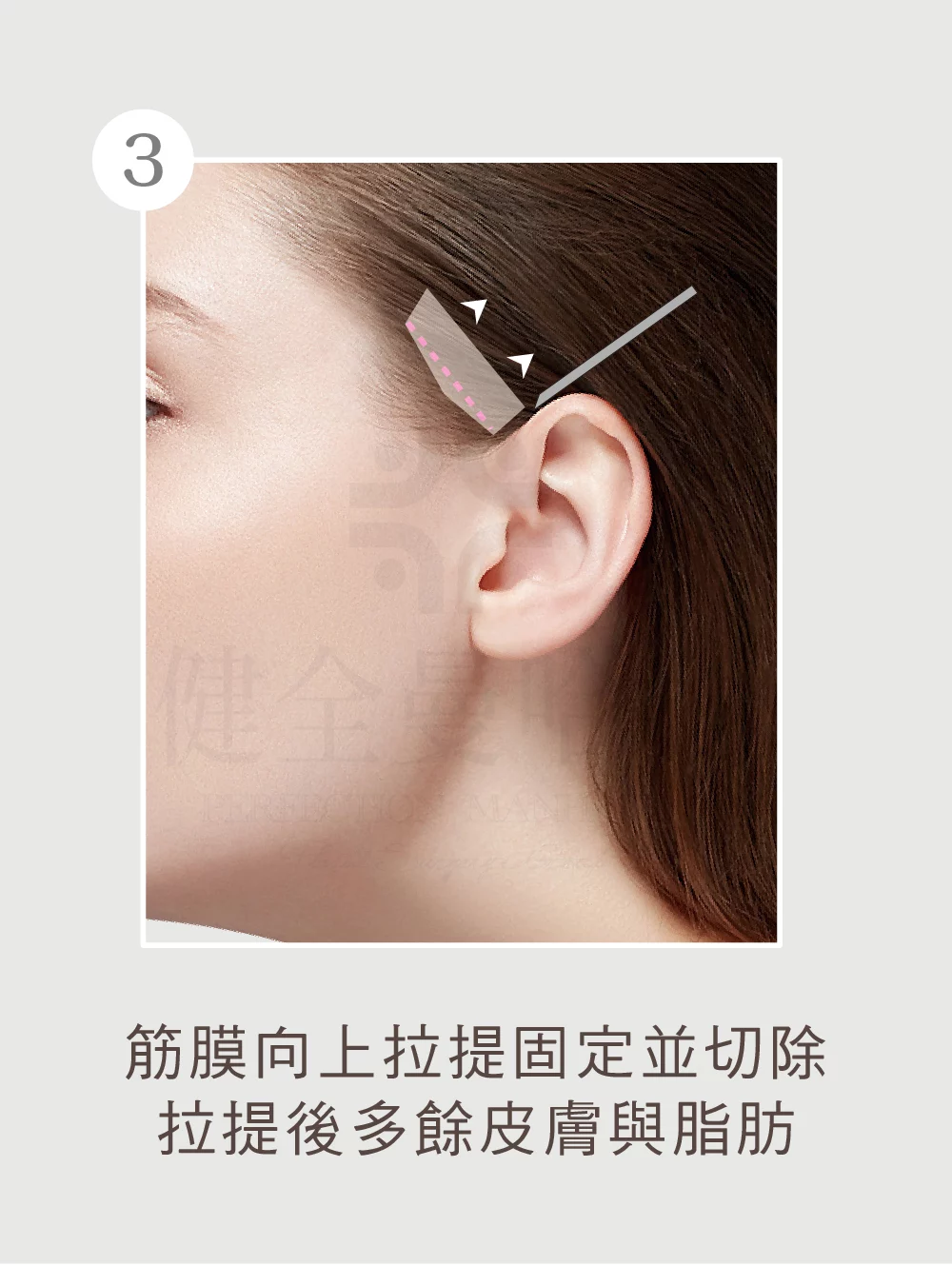 顳側拉皮 顳側 03