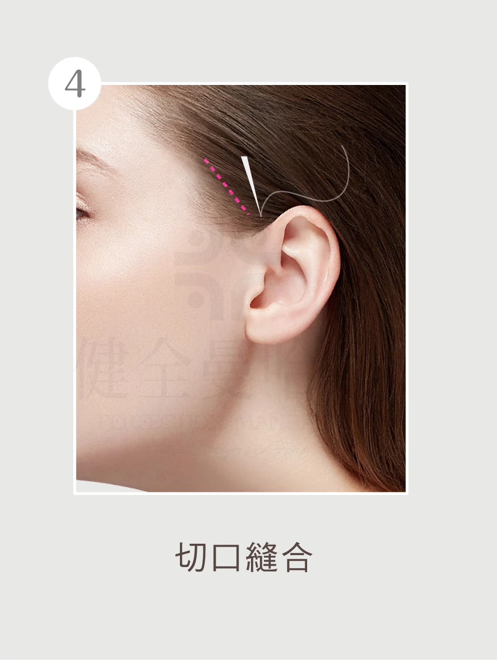 顳側拉皮 顳側 04