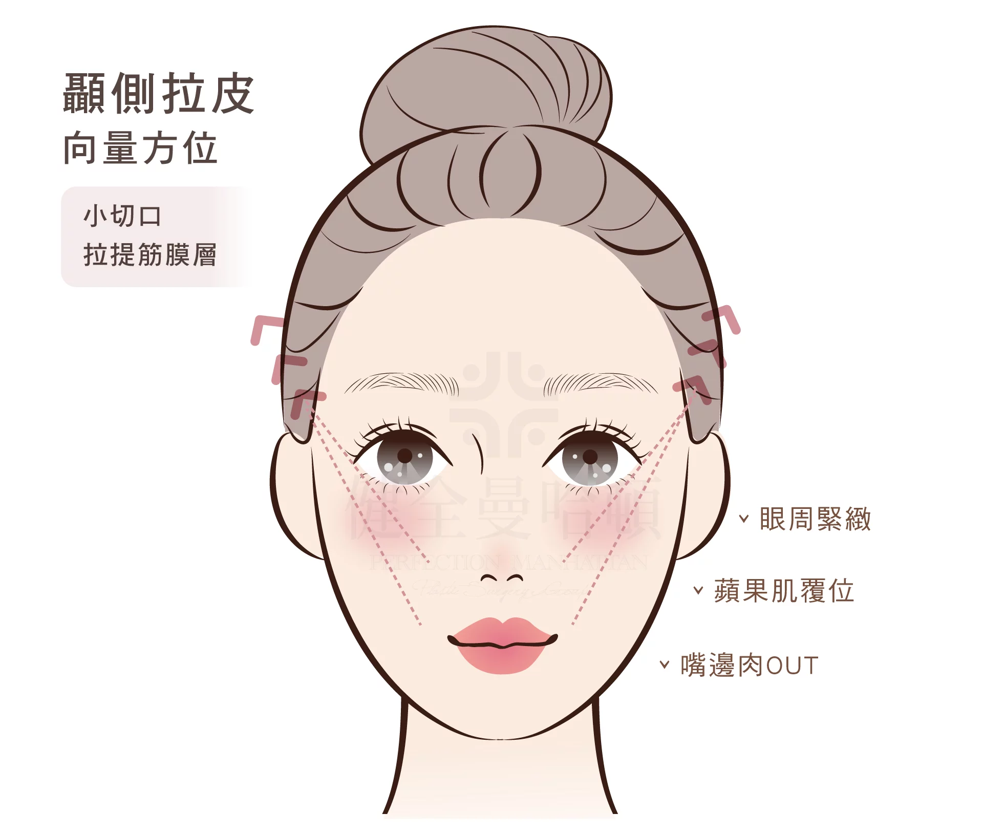 顳側拉皮 顳側拉皮