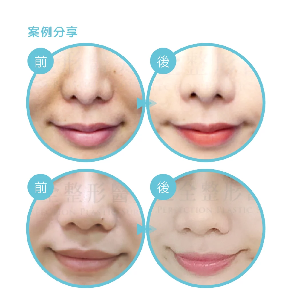 鼻溝槽 鼻溝槽 02