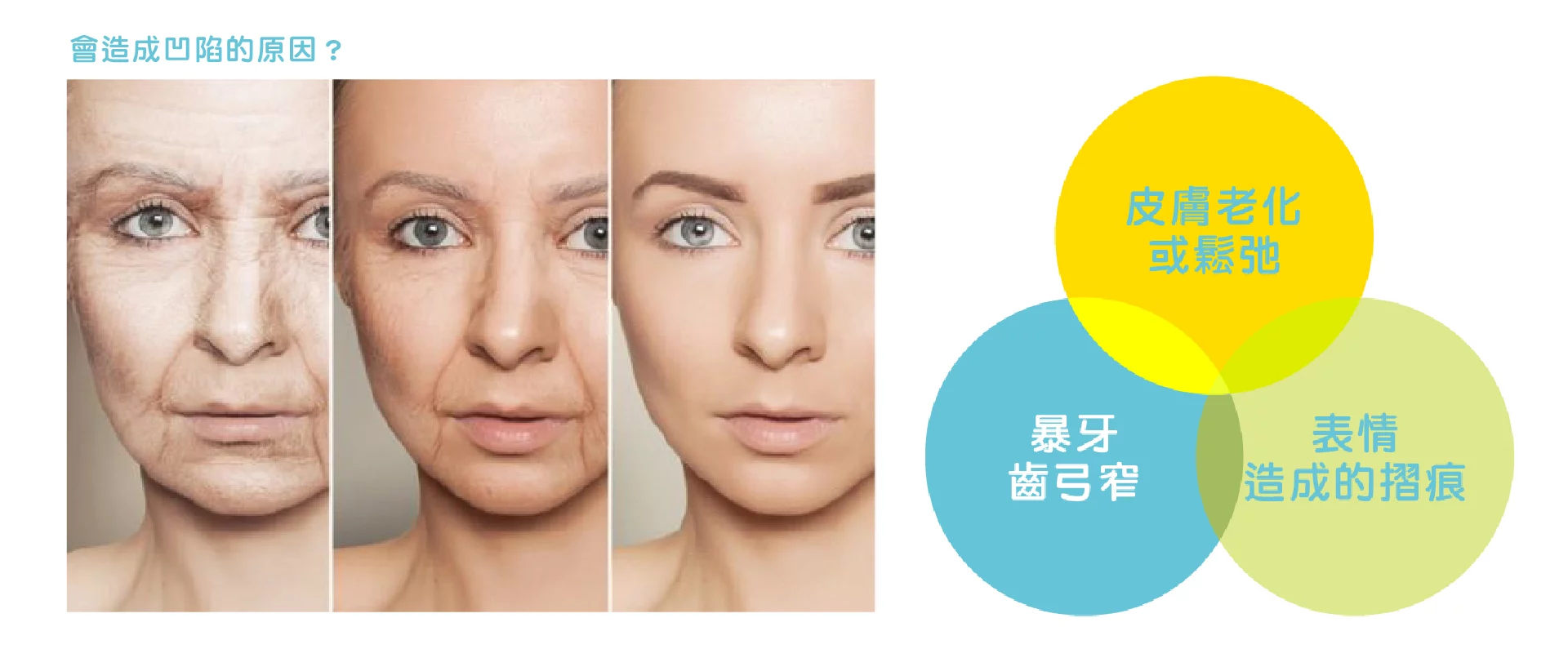 鼻溝槽 鼻溝槽 03