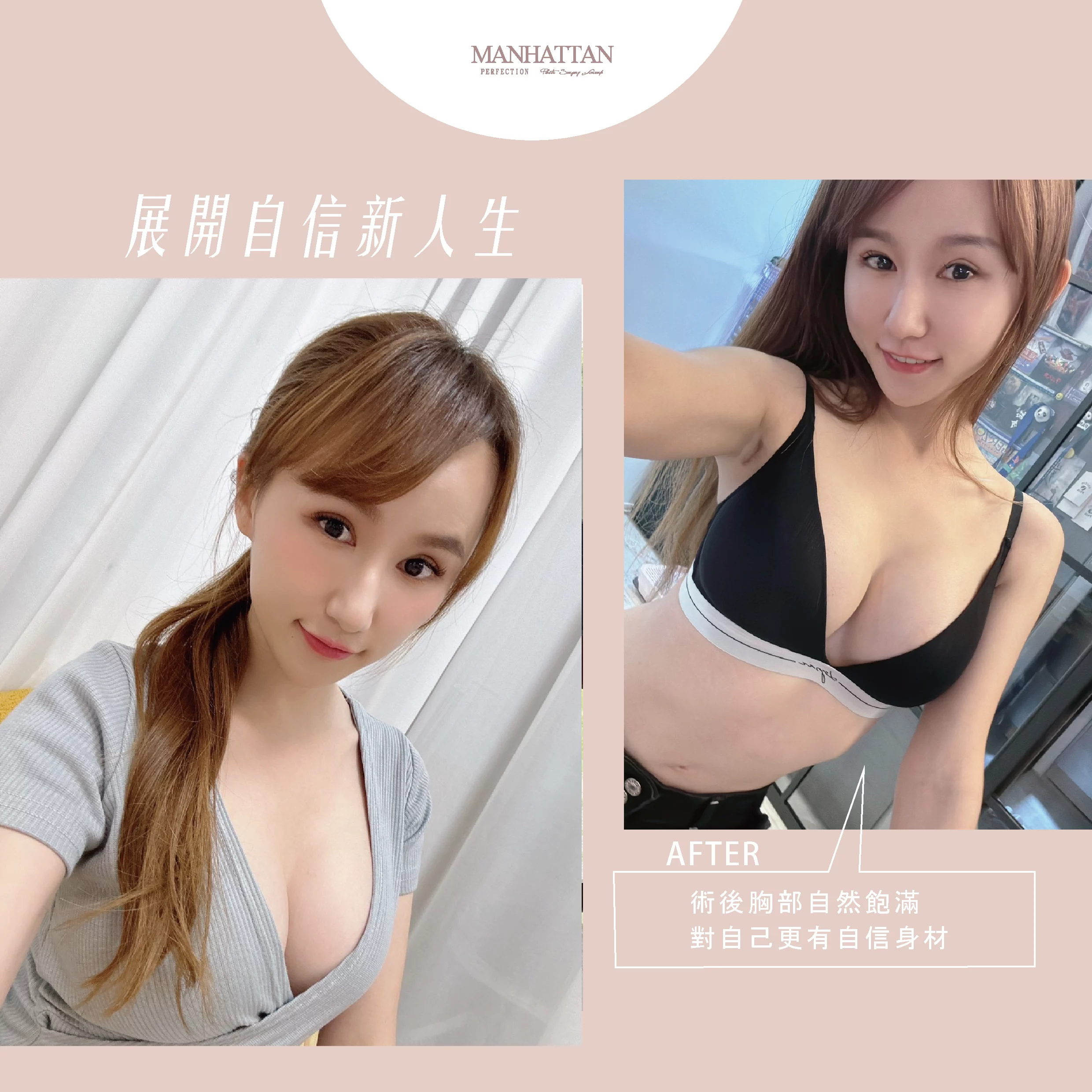 隆乳 郭惠瑜 04